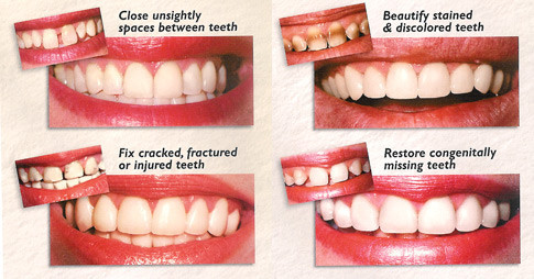 How are broken teeth fixed and treated?