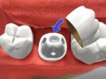 Dental Crown - Restorative Dentistry
