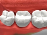 Crown - Restorative Dentistry Belmar