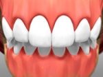 Full Restoration - Cosmetic Dentistry