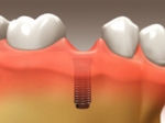 Tooth Implant - Restorative Dentistry