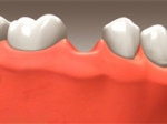 Implants - Restorative Dentistry