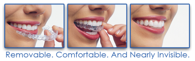 Introducing Invisalign Teen We Consulted